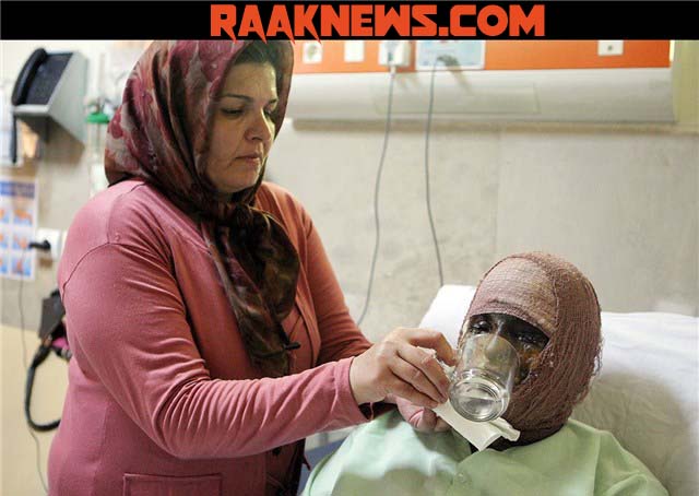 قربانی اسیدپاشی دردهدشت به دادگاه میرود/25عمل جراحی برای بهبودی سیماافشار